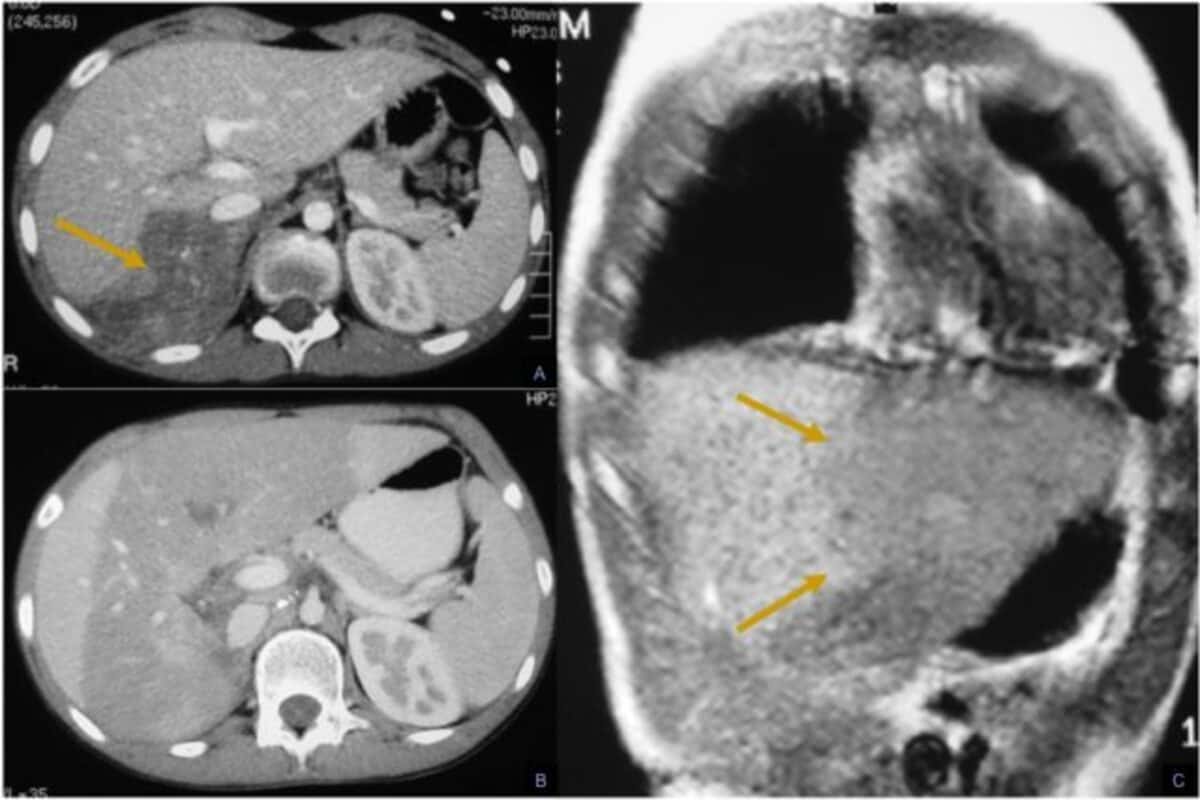 Нейробластома забрюшинного пространства у детей